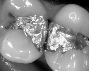 amalgam filling